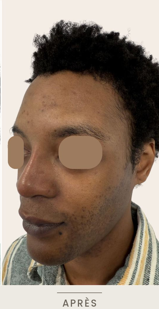 Rhinoplastie médicale à l'acide hyaluronique, vue de trois quarts gauche après l'intervention — Dr David Ganon, chirurgien plasticien à Paris
