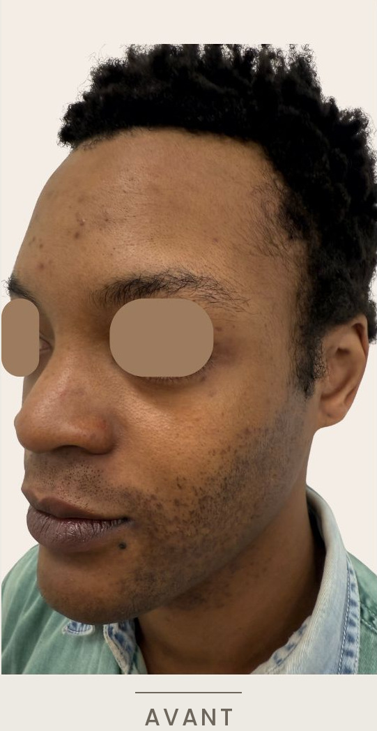 Rhinoplastie médicale à l'acide hyaluronique, vue de trois quarts gauche avant l'intervention — Dr David Ganon, chirurgien plasticien à Paris