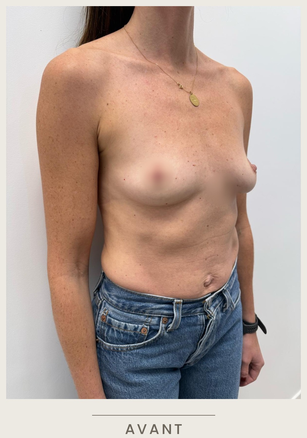 Augmentation mammaire par prothèses, vue de trois quarts gauche avant l'intervention — Dr David Ganon, chirurgien plasticien à Paris