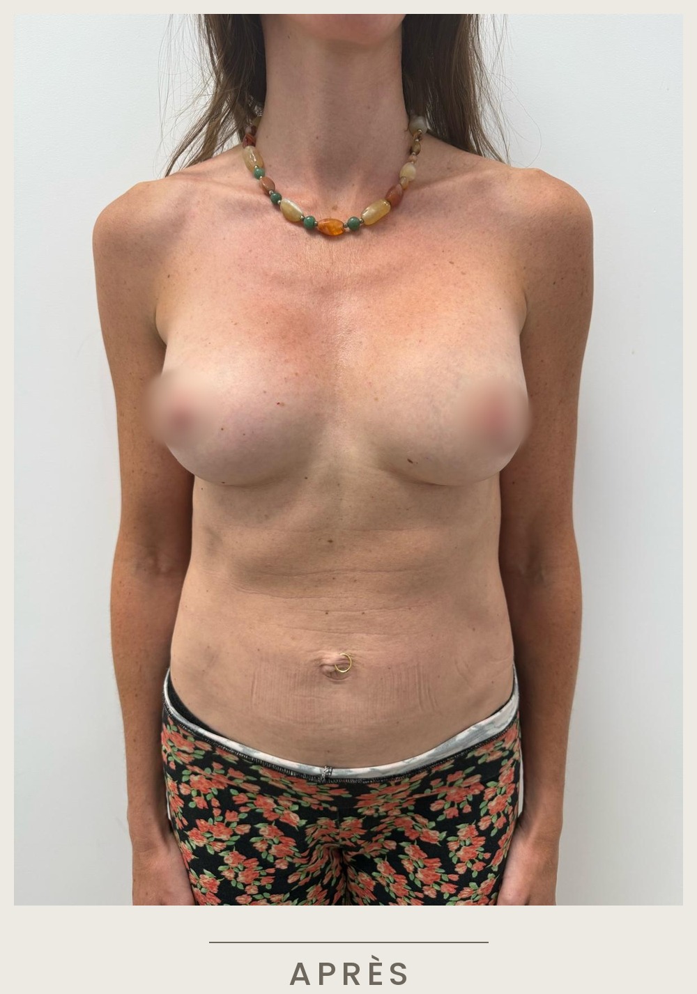 Augmentation mammaire par prothèses, vue de face après l'intervention — Dr David Ganon, chirurgien plasticien à Paris