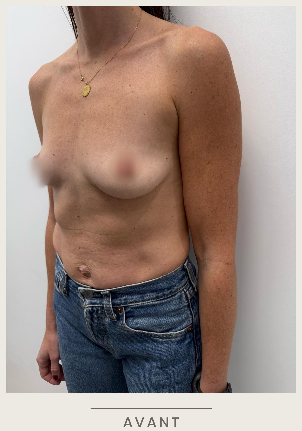 Augmentation mammaire par prothèses, vue de trois quarts droit avant l'intervention — Dr David Ganon, chirurgien plasticien à Paris