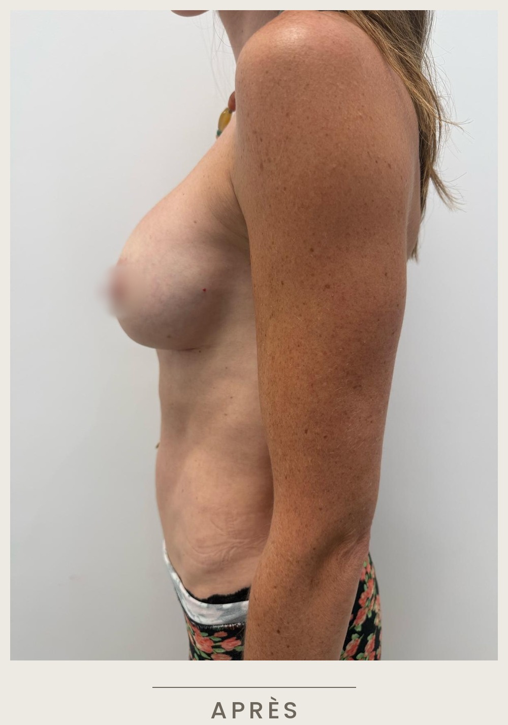 Augmentation mammaire par prothèses, vue de profil gauche après l'intervention — Dr David Ganon, chirurgien plasticien à Paris