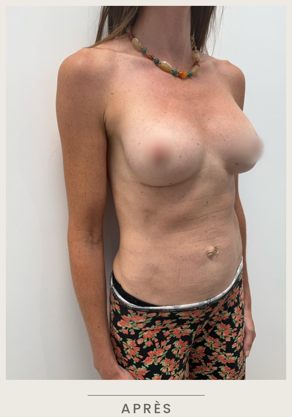 Augmentation mammaire par prothèses, vue de trois quarts droit après l'intervention — Dr David Ganon, chirurgien plasticien à Paris