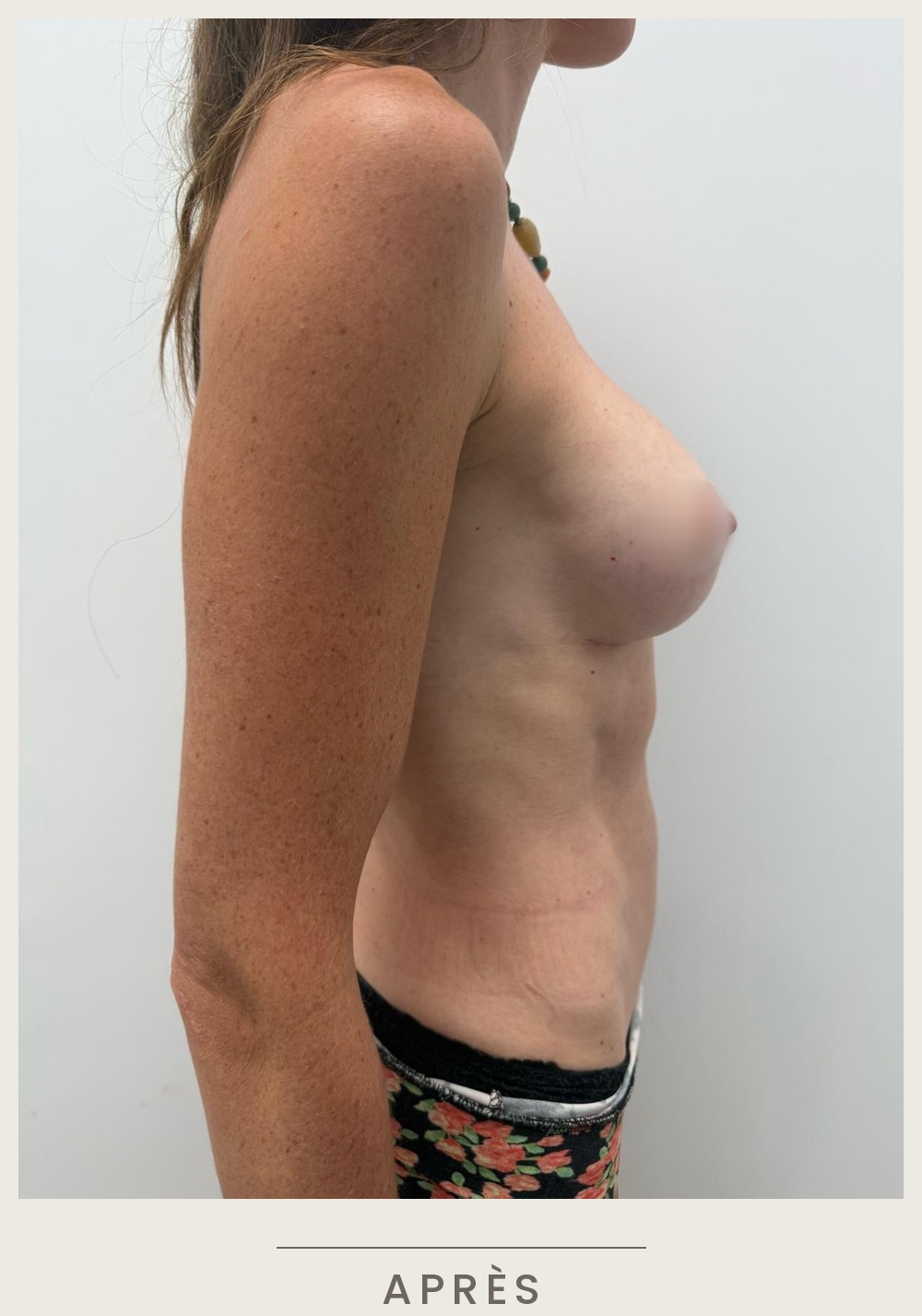 Augmentation mammaire par prothèses, vue de profil droit après l'intervention — Dr David Ganon, chirurgien plasticien à Paris