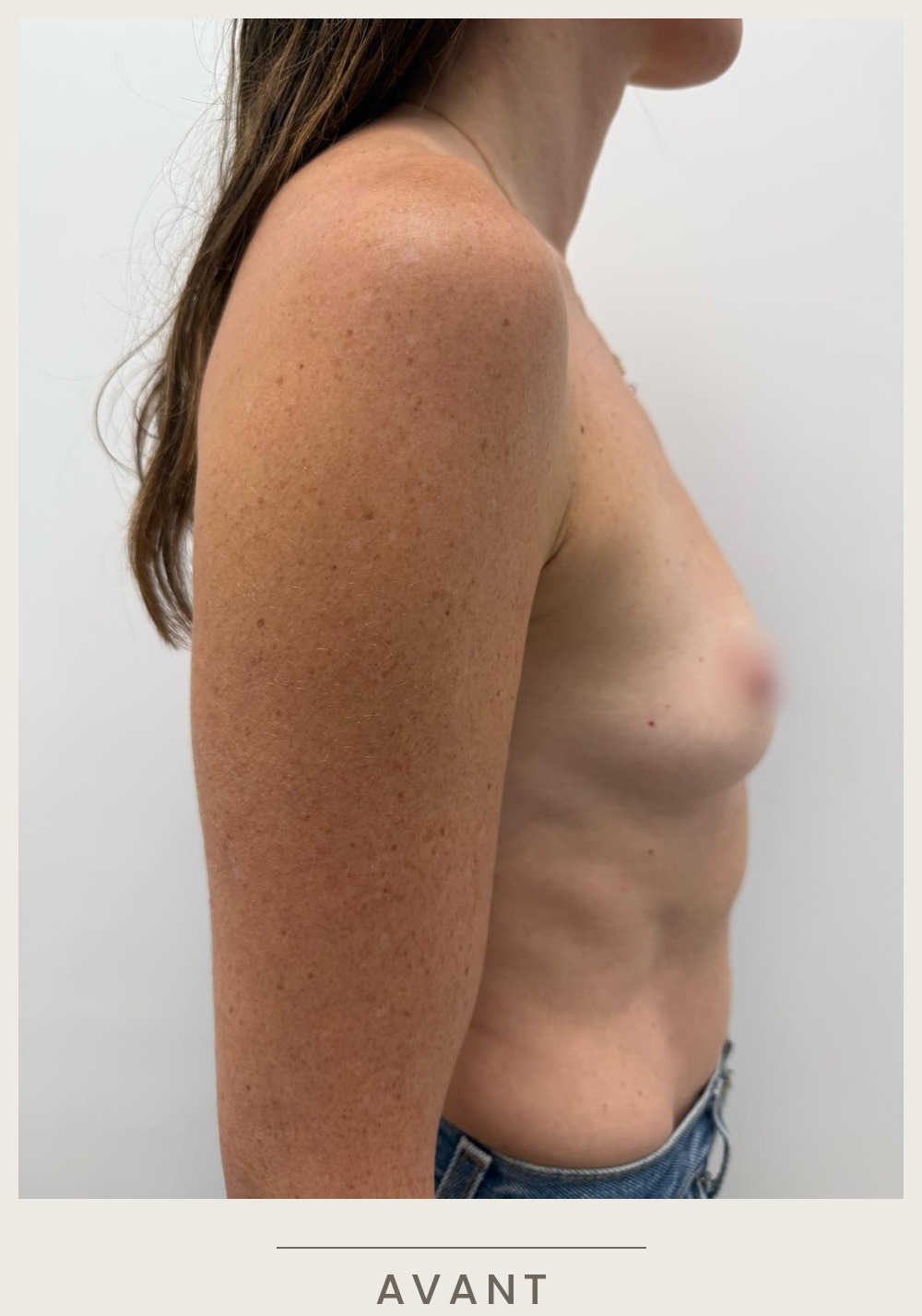 Augmentation mammaire par prothèses, vue de profil droit avant l'intervention — Dr David Ganon, chirurgien plasticien à Paris