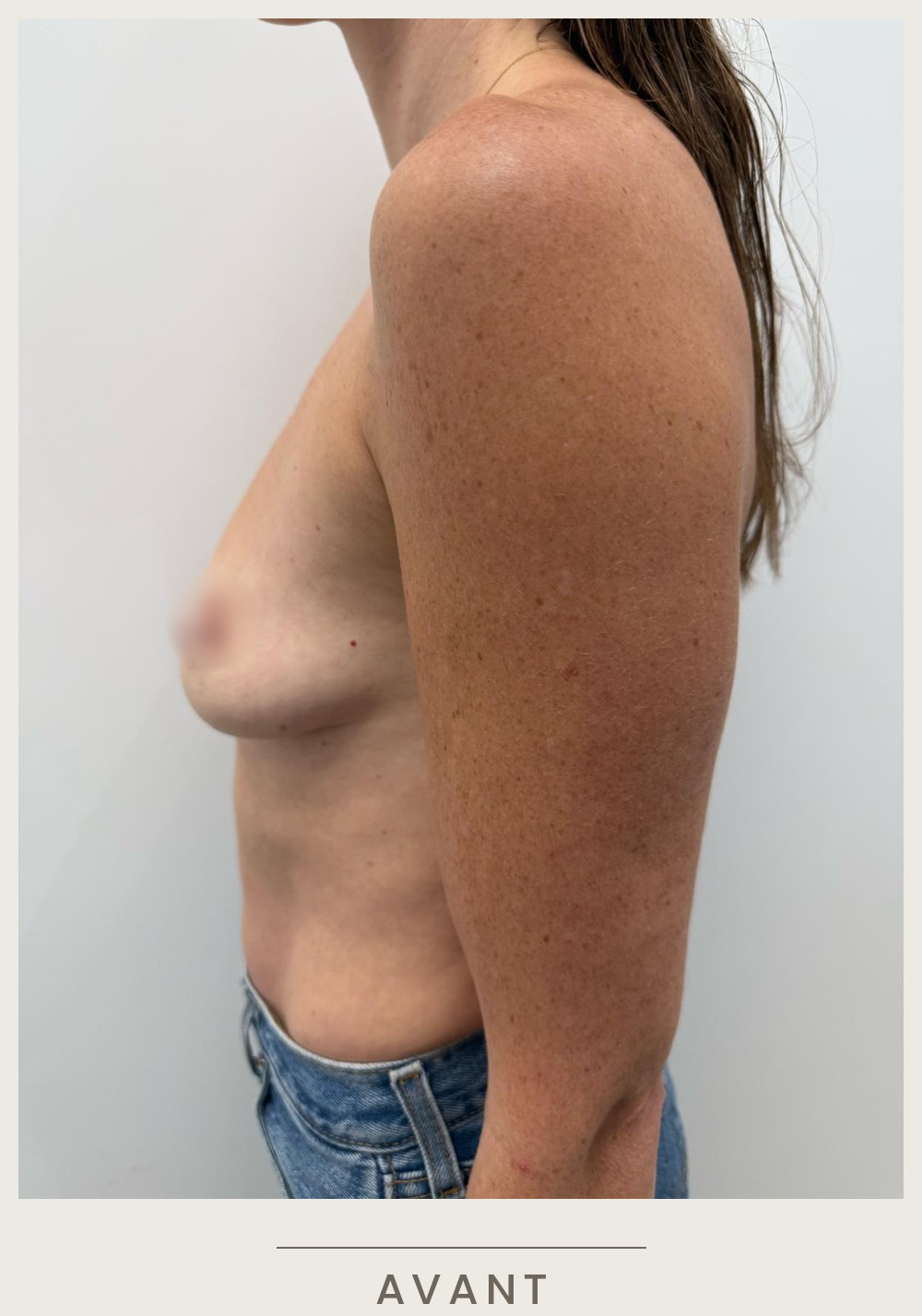 Augmentation mammaire par prothèses, vue de profil gauche avant l'intervention — Dr David Ganon, chirurgien plasticien à Paris