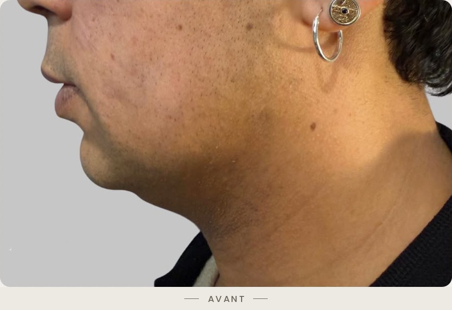 Lifting du cou par radiofréquence Quantum, profil gauche avant l'intervention — Dr David Ganon, chirurgien plasticien à Paris