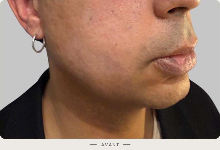 Lifting du cou par radiofréquence Quantum, trois quarts droit avant l'intervention — Dr David Ganon, chirurgien plasticien à Paris