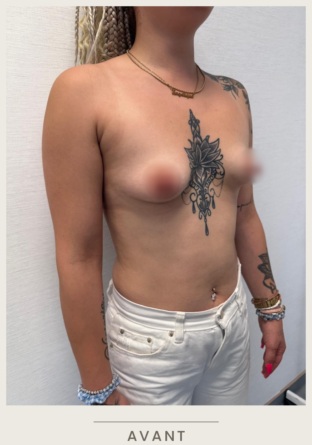 Augmentation mammaire par prothèses, vue de trois quarts gauche avant l'intervention — Dr David Ganon, chirurgien plasticien à Paris