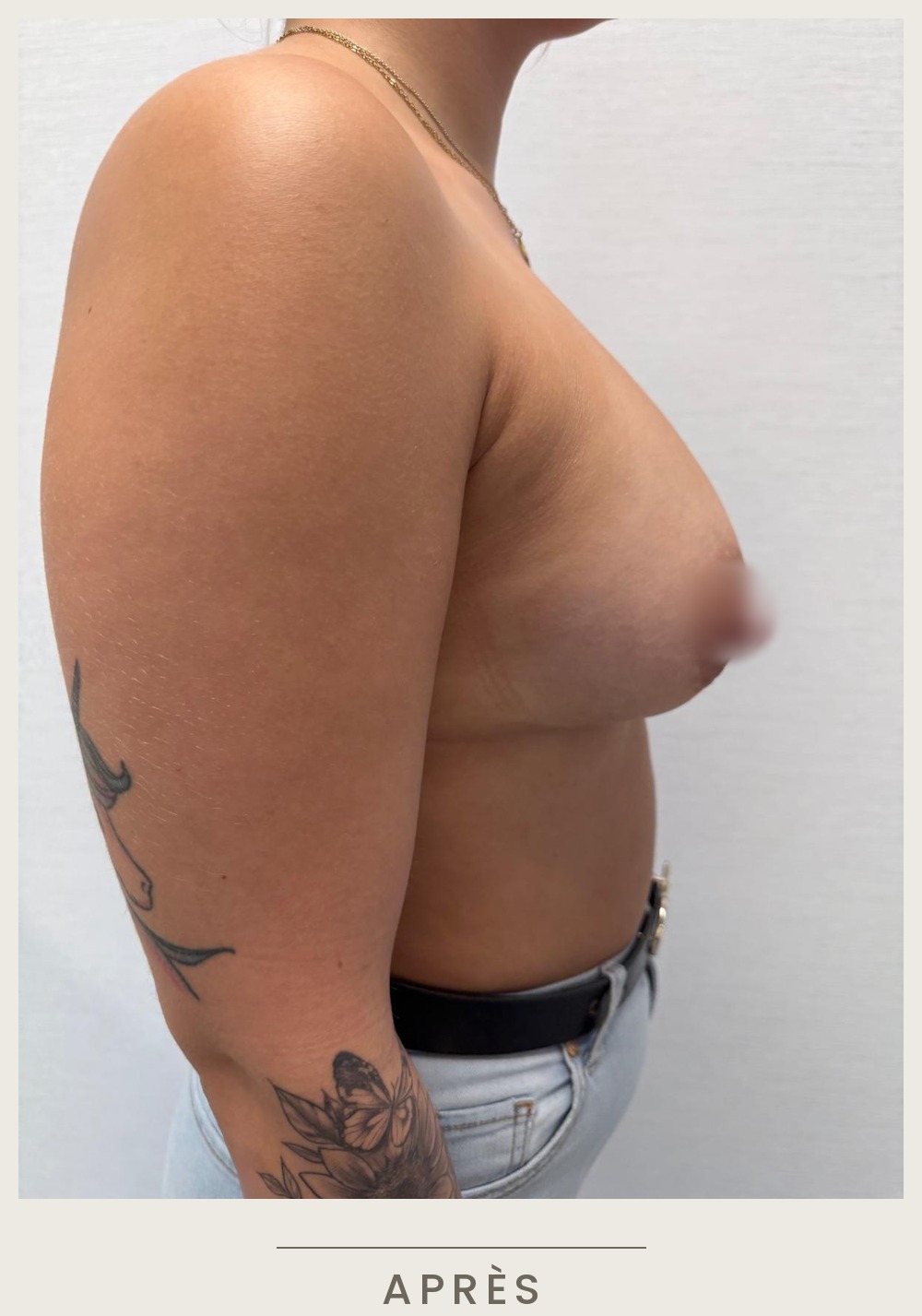 Augmentation mammaire par prothèses, vue de profil droit après l'intervention — Dr David Ganon, chirurgien plasticien à Paris