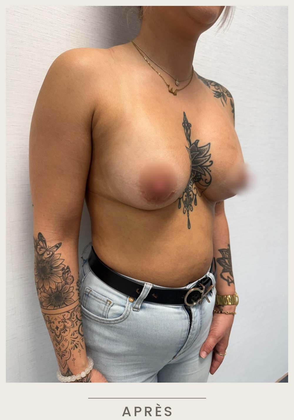 Augmentation mammaire par prothèses, vue de trois quarts gauche après l'intervention — Dr David Ganon, chirurgien plasticien à Paris