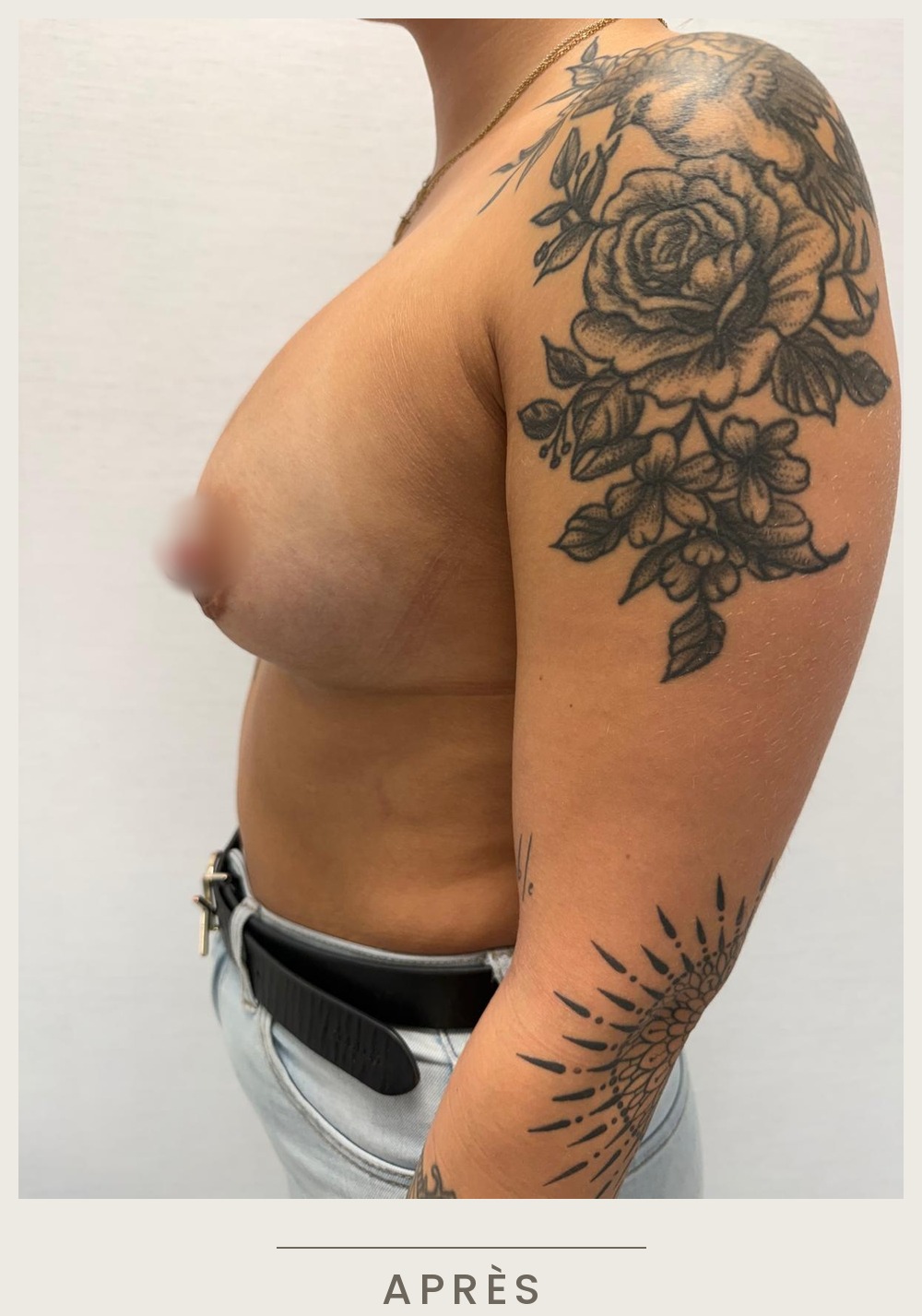 Augmentation mammaire par prothèses, vue de profil gauche après l'intervention — Dr David Ganon, chirurgien plasticien à Paris