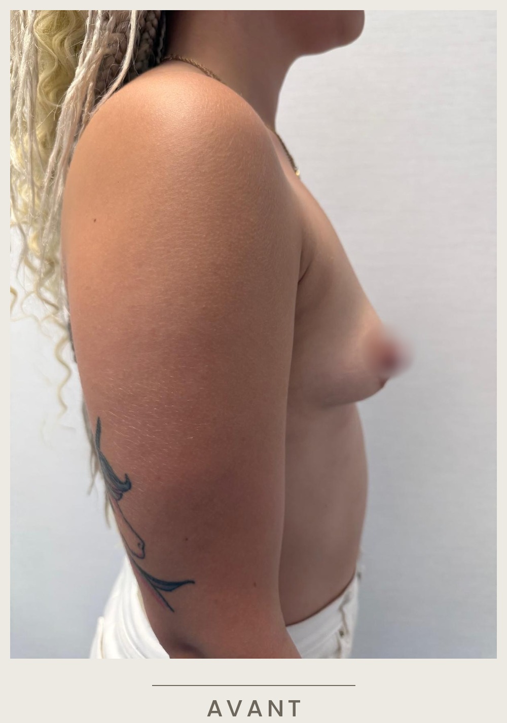 Augmentation mammaire par prothèses, vue de profil droit avant l'intervention — Dr David Ganon, chirurgien plasticien à Paris