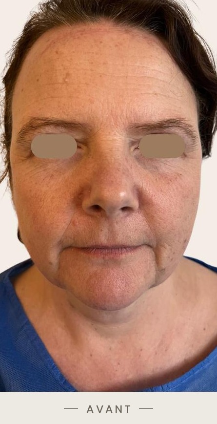 Lifting du cou par radiofréquence Quantum, vue de face avant l'intervention — Dr David Ganon, chirurgien plasticien à Paris