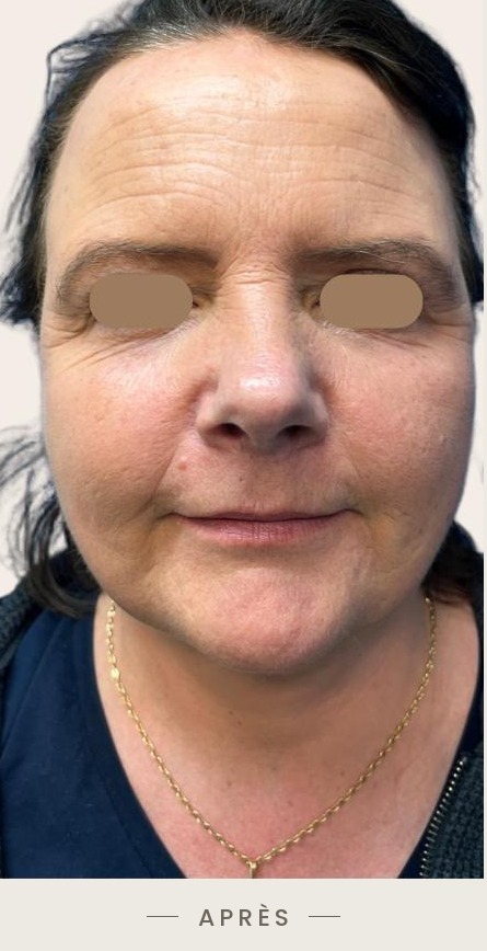 Lifting du cou par radiofréquence Quantum, vue de face un mois et demi après l'intervention — Dr David Ganon, chirurgien plasticien à Paris