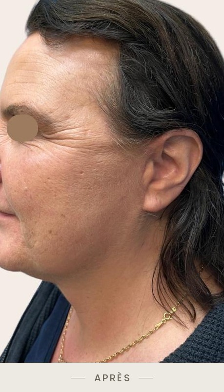 Lifting du cou par radiofréquence Quantum, profil gauche un mois et demi après l'intervention — Dr David Ganon, chirurgien plasticien à Paris