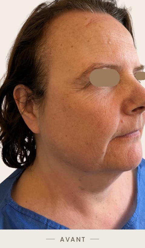 Lifting du cou par radiofréquence Quantum, trois quarts droit avant l'intervention — Dr David Ganon, chirurgien plasticien à Paris