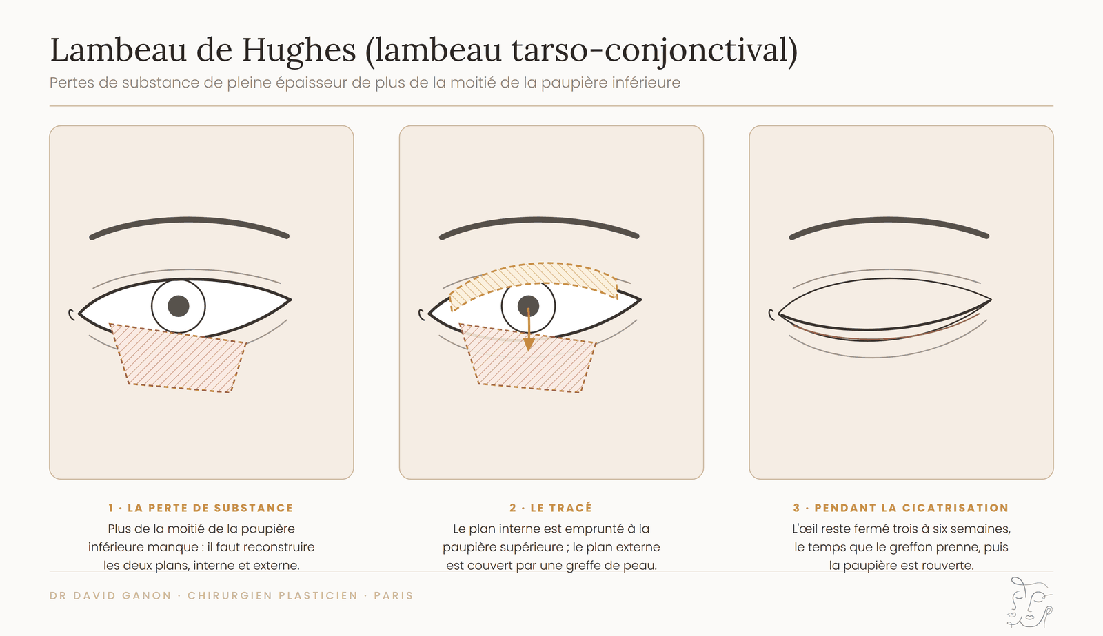 Schéma du lambeau de Hughes tarso-conjonctival pour une perte de substance étendue de la paupière inférieure