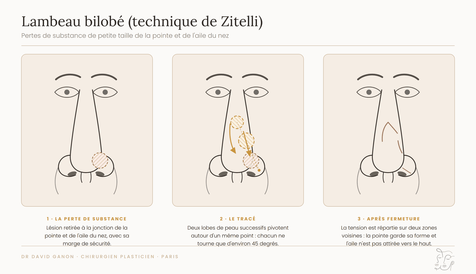 Schéma du lambeau bilobé de Zitelli pour une perte de substance de l'aile du nez