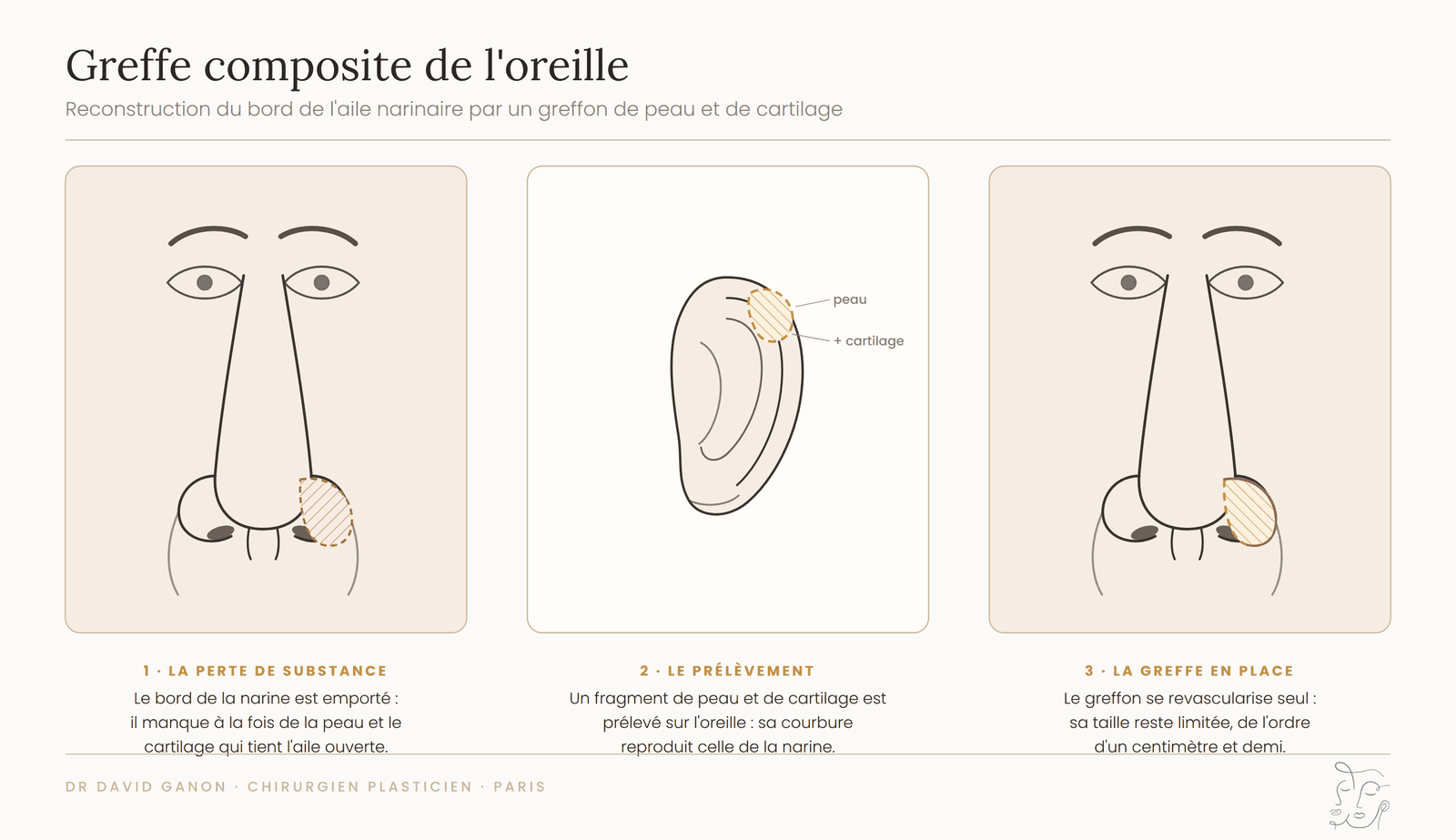 Schéma d'une greffe composite prélevée sur l'oreille pour reconstruire le bord de l'aile narinaire