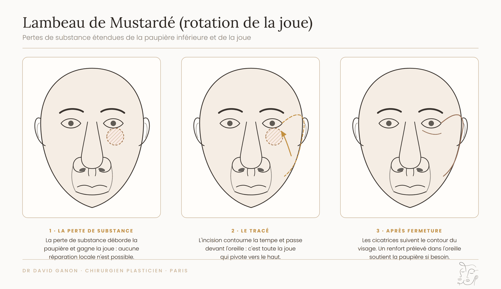 Schéma du lambeau de Mustardé : rotation de la joue pour reconstruire la paupière inférieure