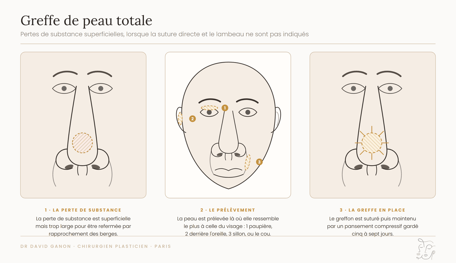 Schéma d'une greffe de peau totale du visage : perte de substance, zones de prélèvement et greffe en place
