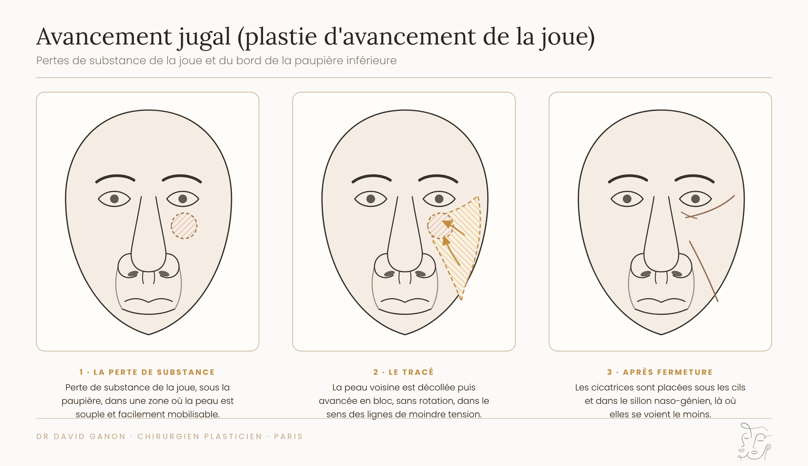Schéma de l'avancement jugal pour une perte de substance de la joue et de la paupière inférieure