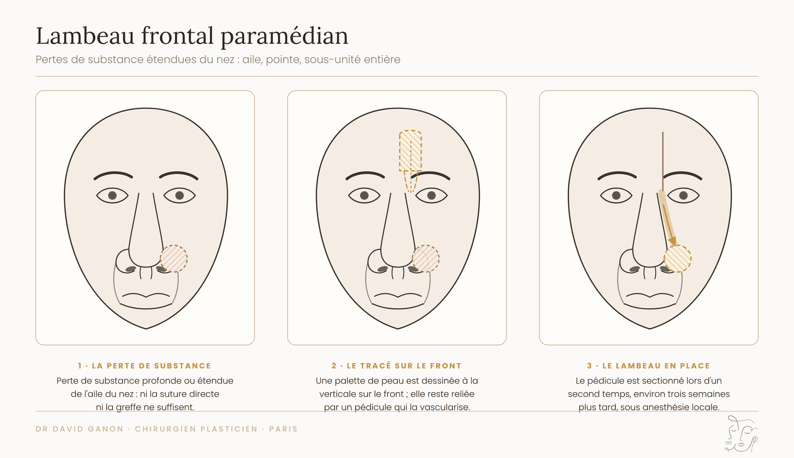 Schéma du lambeau frontal paramédian : palette de peau prélevée sur le front et basculée sur le nez