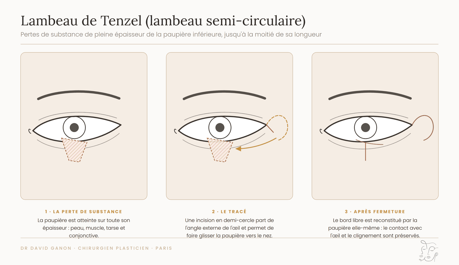 Schéma du lambeau de Tenzel semi-circulaire pour une perte de substance de la paupière inférieure