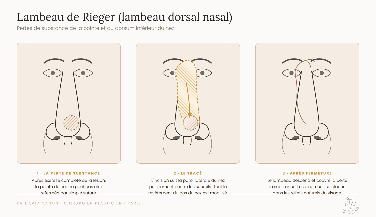 Schéma du lambeau de Rieger : perte de substance de la pointe du nez, tracé du lambeau dorsal nasal et aspect après fermeture