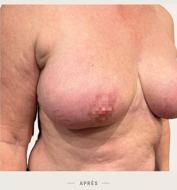 Lifting des seins par mastopexie, trois quarts droit après l'intervention — Dr David Ganon, chirurgien plasticien à Paris