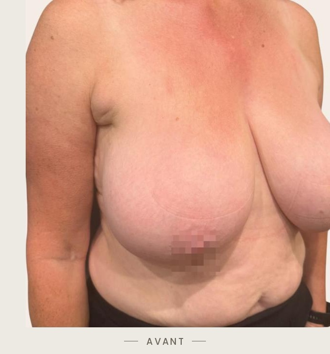 Lifting des seins par mastopexie, trois quarts droit avant l'intervention — Dr David Ganon, chirurgien plasticien à Paris
