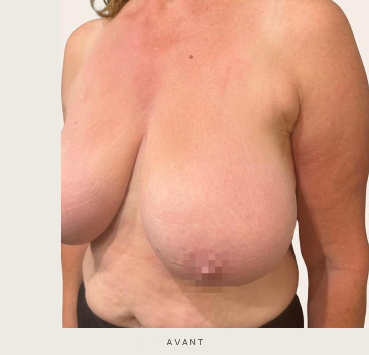 Lifting des seins par mastopexie, trois quarts gauche avant l'intervention — Dr David Ganon, chirurgien plasticien à Paris
