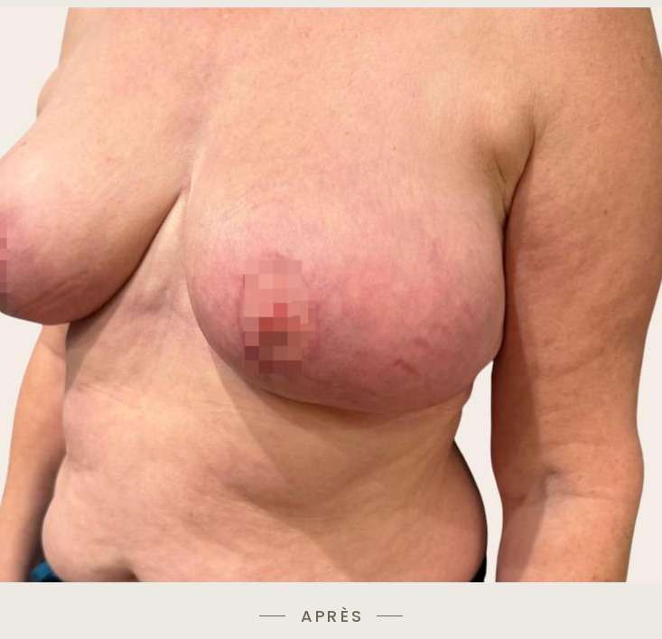 Lifting des seins par mastopexie, trois quarts gauche après l'intervention — Dr David Ganon, chirurgien plasticien à Paris