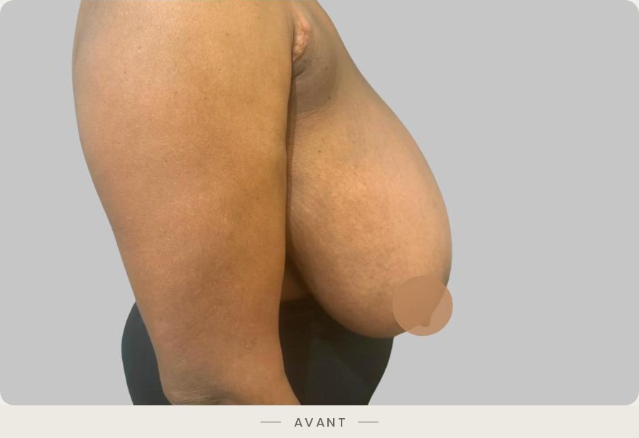 Lifting des seins par mastopexie, profil droit avant l'intervention — Dr David Ganon, chirurgien plasticien à Paris