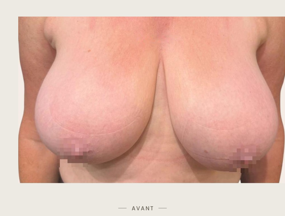 Lifting des seins par mastopexie, vue de face avant l'intervention — Dr David Ganon, chirurgien plasticien à Paris