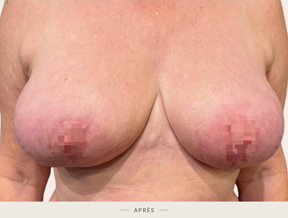 Lifting des seins par mastopexie, vue de face après l'intervention — Dr David Ganon, chirurgien plasticien à Paris