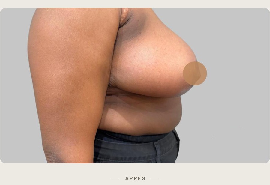 Lifting des seins par mastopexie, profil droit après l'intervention — Dr David Ganon, chirurgien plasticien à Paris