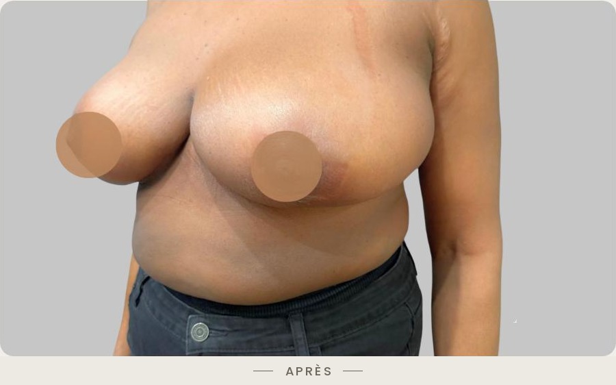 Lifting des seins par mastopexie, trois quarts droit après l'intervention — Dr David Ganon, chirurgien plasticien à Paris