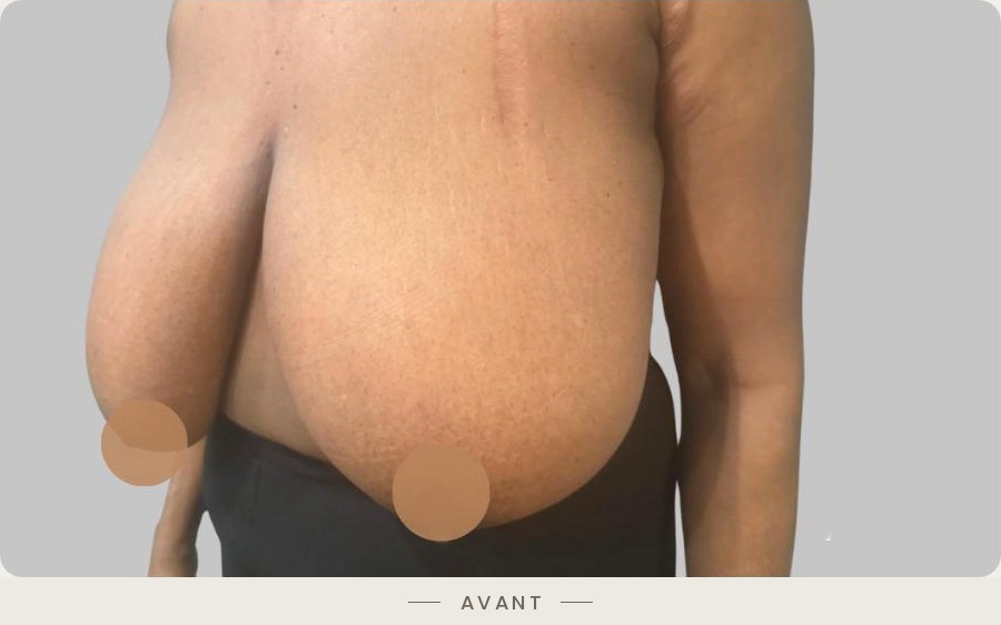 Lifting des seins par mastopexie, trois quarts droit avant l'intervention — Dr David Ganon, chirurgien plasticien à Paris