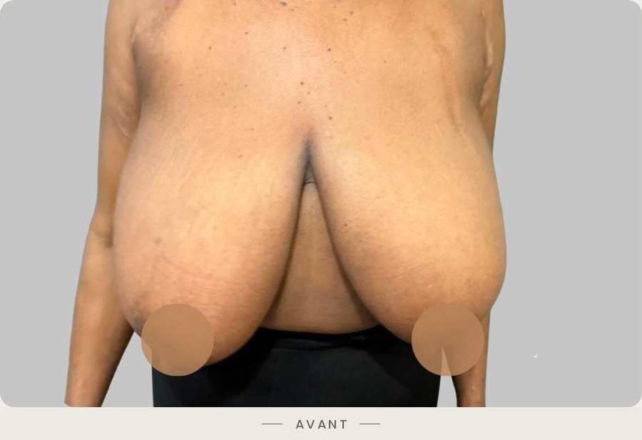 Lifting des seins par mastopexie, vue de face avant l'intervention — Dr David Ganon, chirurgien plasticien à Paris