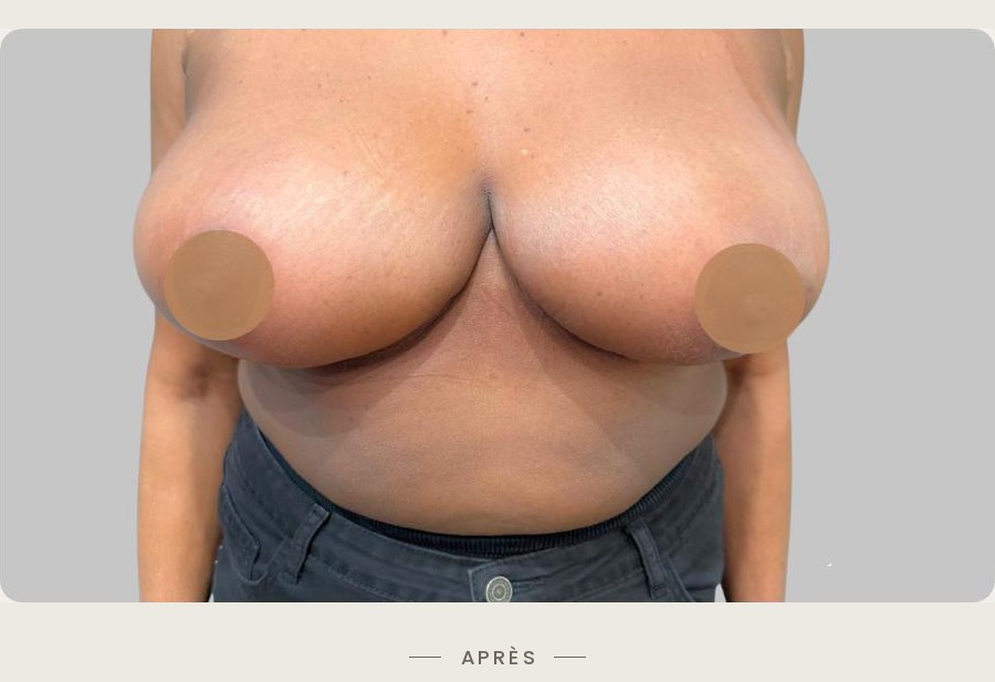 Lifting des seins par mastopexie, vue de face après l'intervention — Dr David Ganon, chirurgien plasticien à Paris