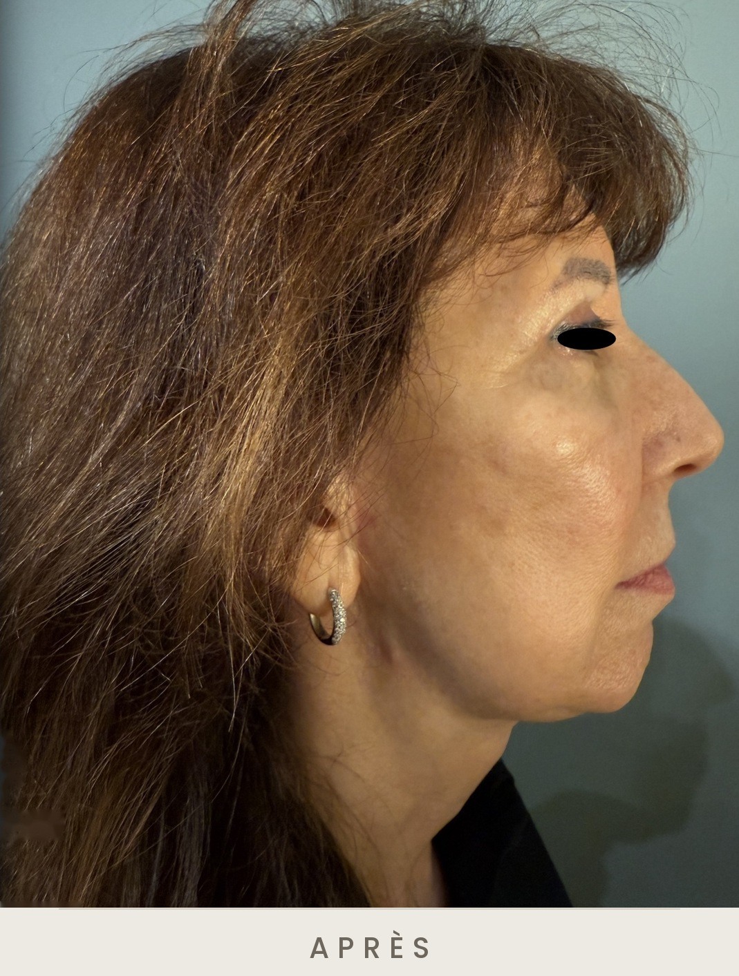Lifting cervico-facial, profil droit après l'intervention — Dr David Ganon, chirurgien plasticien à Paris