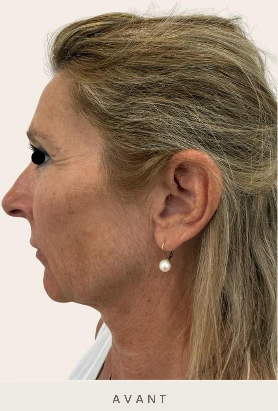 Lifting cervico-facial et blépharoplastie supérieure, profil droit avant l'intervention — Dr David Ganon, chirurgien plasticien à Paris