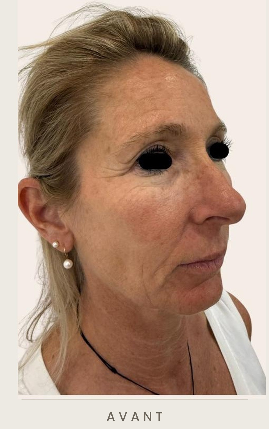 Lifting cervico-facial et blépharoplastie supérieure, trois quarts droit avant l'intervention — Dr David Ganon, chirurgien plasticien à Paris