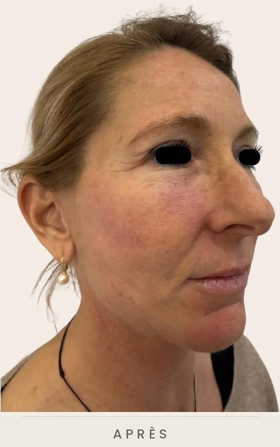 Lifting cervico-facial et blépharoplastie supérieure, trois quarts droit après l'intervention — Dr David Ganon, chirurgien plasticien à Paris
