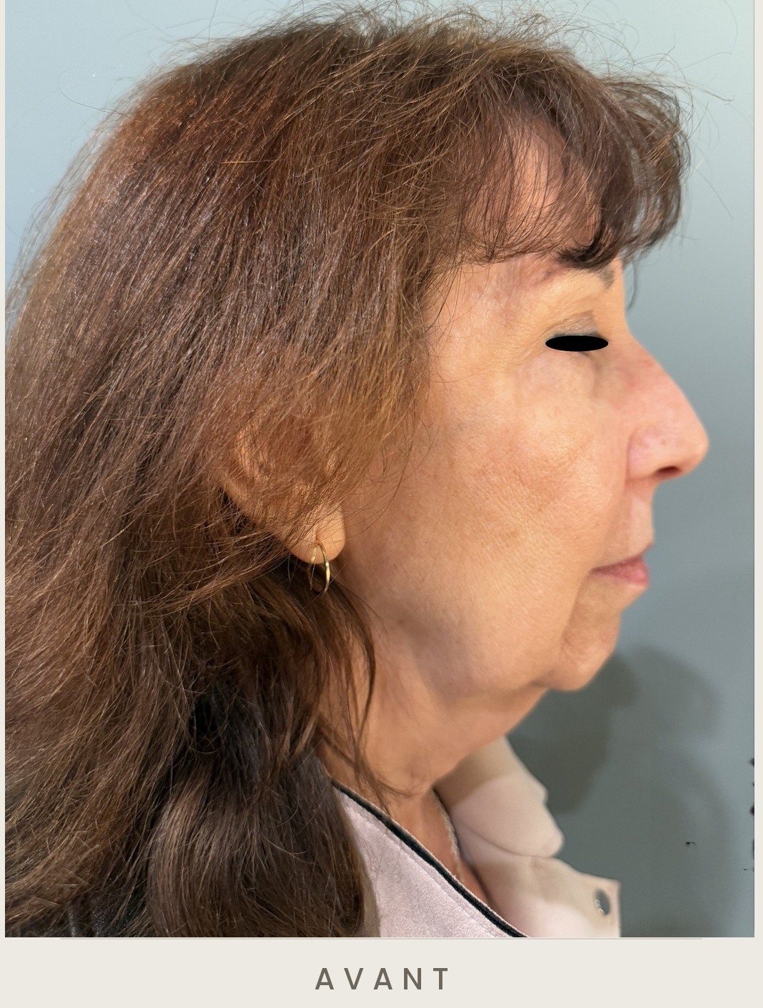 Lifting cervico-facial, profil droit avant l'intervention — Dr David Ganon, chirurgien plasticien à Paris