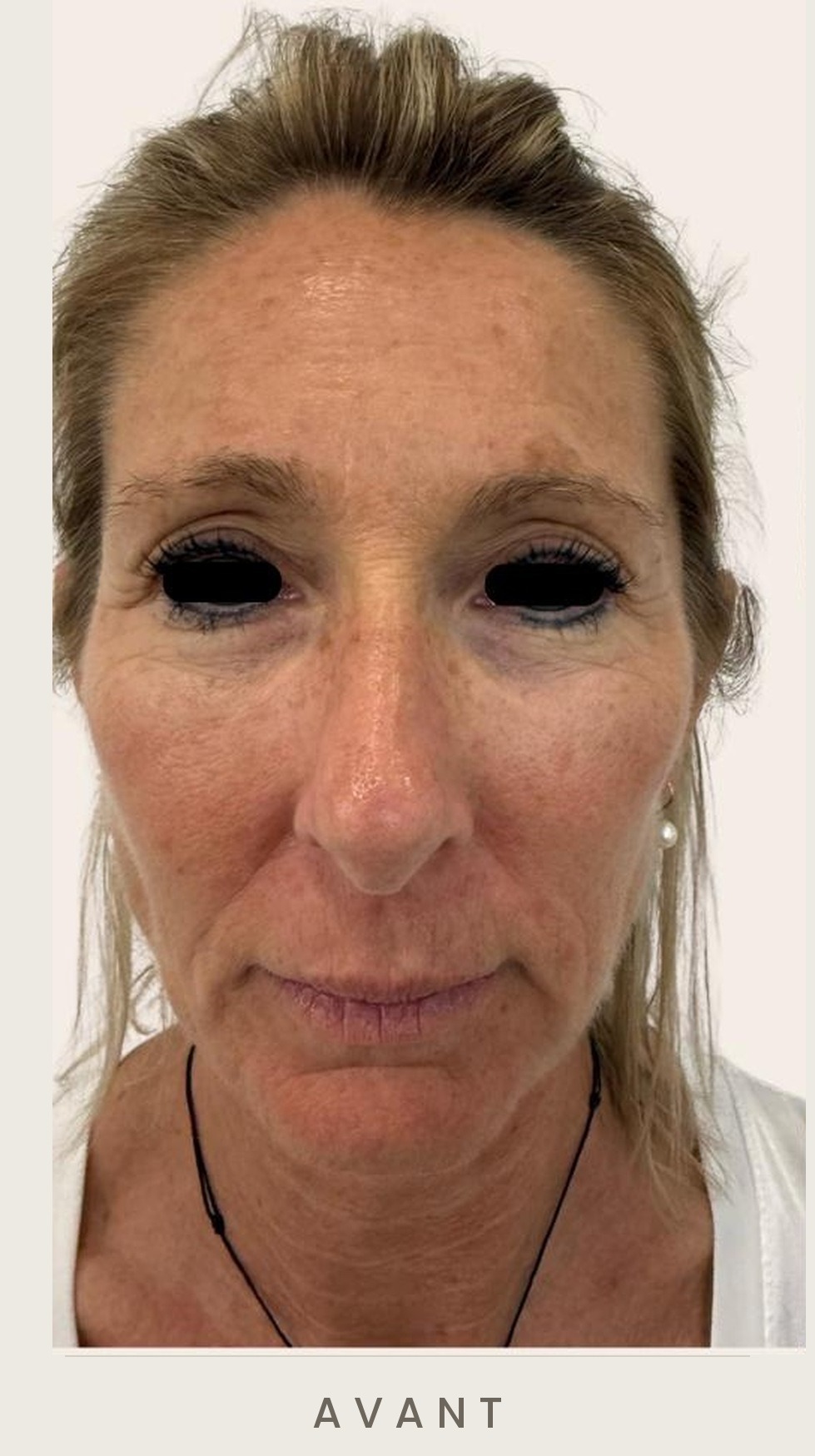 Lifting cervico-facial et blépharoplastie supérieure, vue de face avant l'intervention — Dr David Ganon, chirurgien plasticien à Paris
