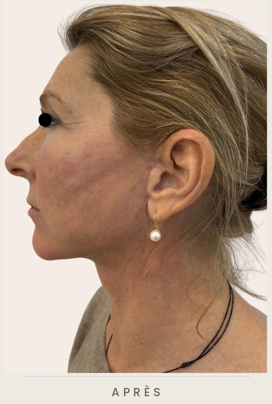 Lifting cervico-facial et blépharoplastie supérieure, profil droit après l'intervention — Dr David Ganon, chirurgien plasticien à Paris