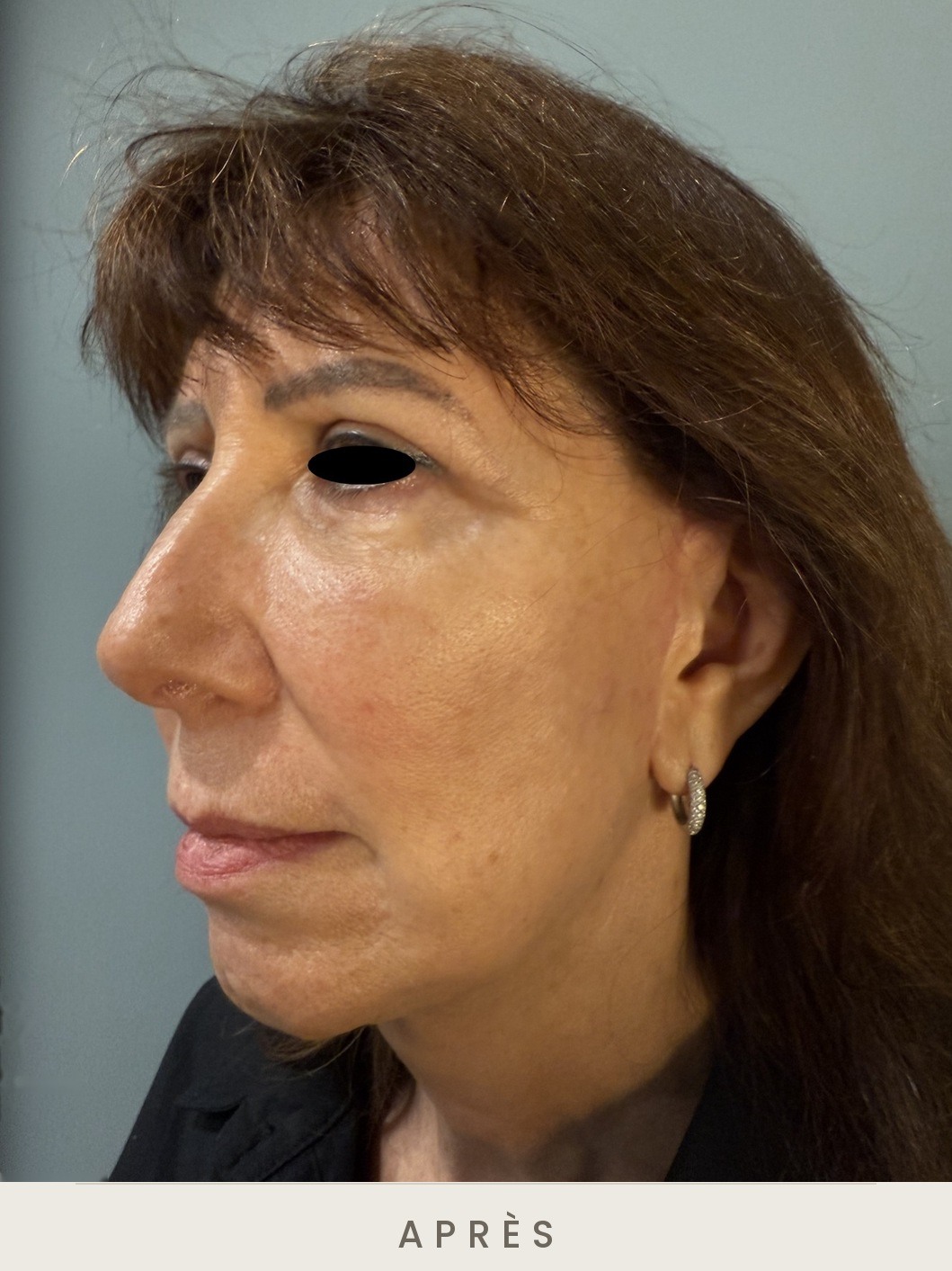 Lifting cervico-facial, trois quarts gauche après l'intervention — Dr David Ganon, chirurgien plasticien à Paris